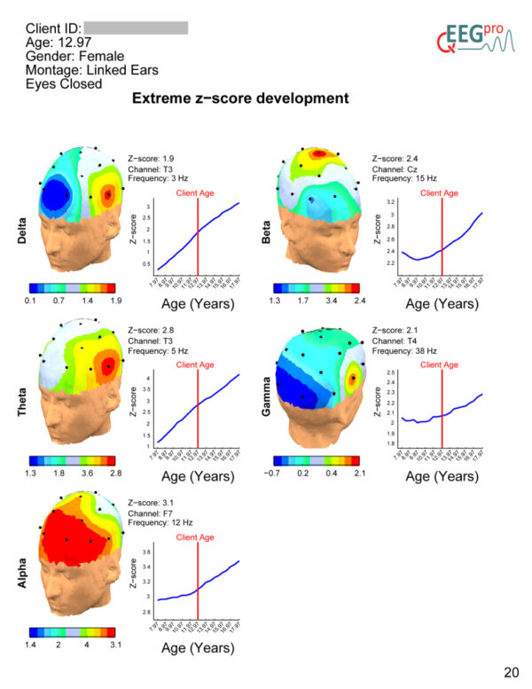 extreme z score development